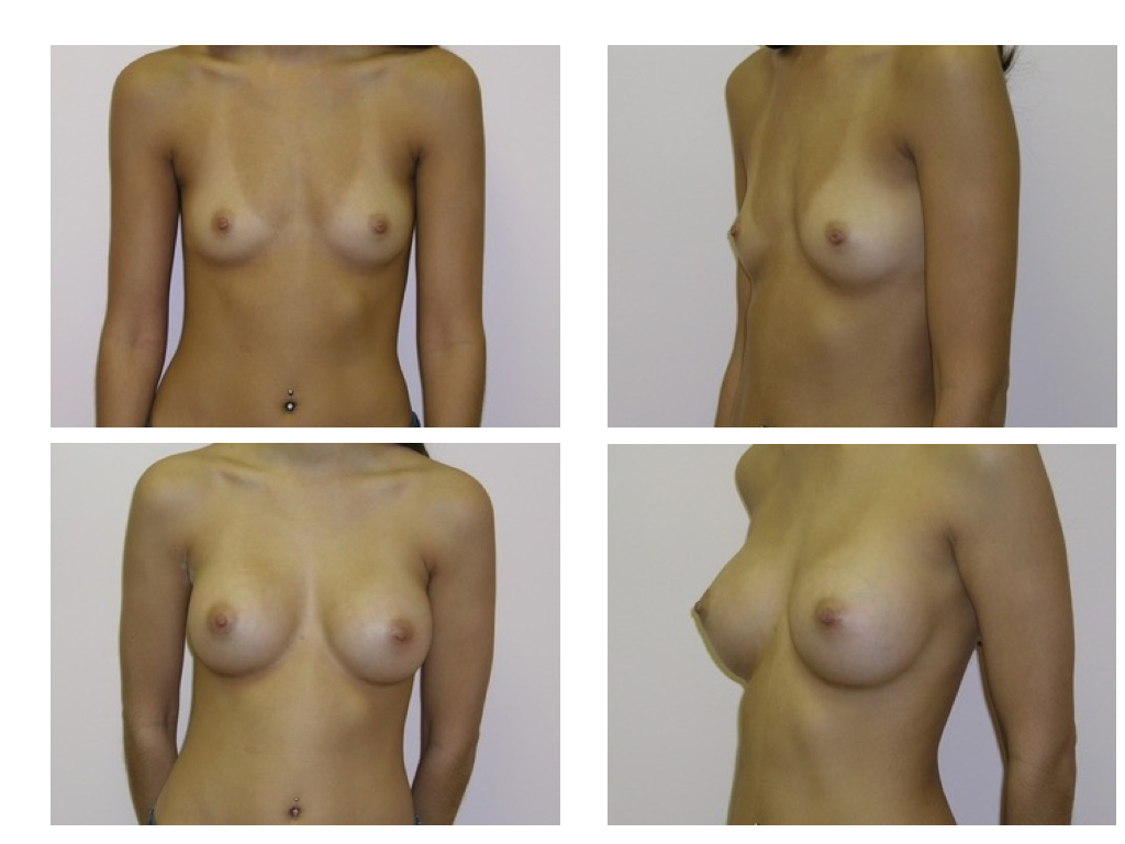 BREAST AUGMENTATION